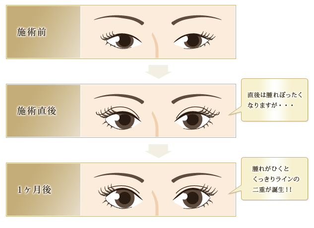 二重の施術前・施術後